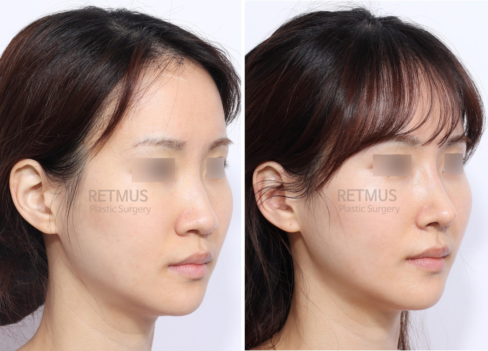 인중코 1개월차 [코성형+콧볼축소] (Rhinoplasty + alar reduction)