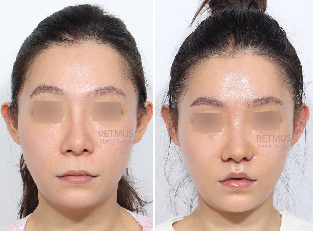 인중코 1주차 [인중축소+코재수술] (upper lip lift + Revision Rhinoplasty)