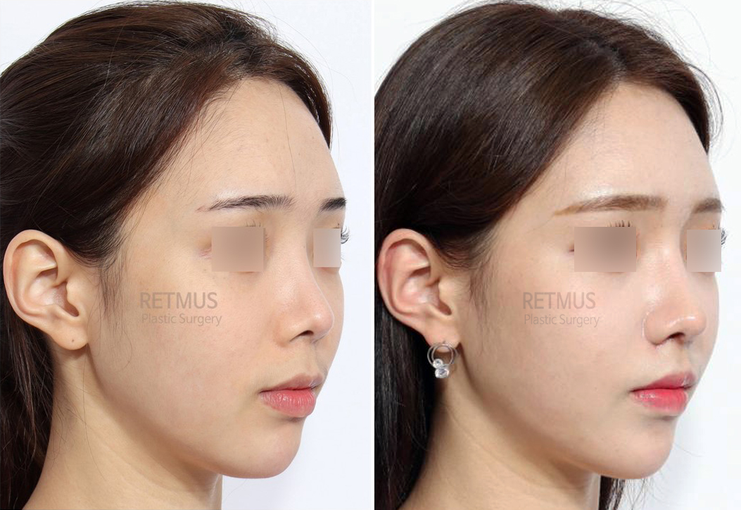 인중코 1개월차 [인중축소+코재수술] (upper lip lift + Revision Rhinoplasty)