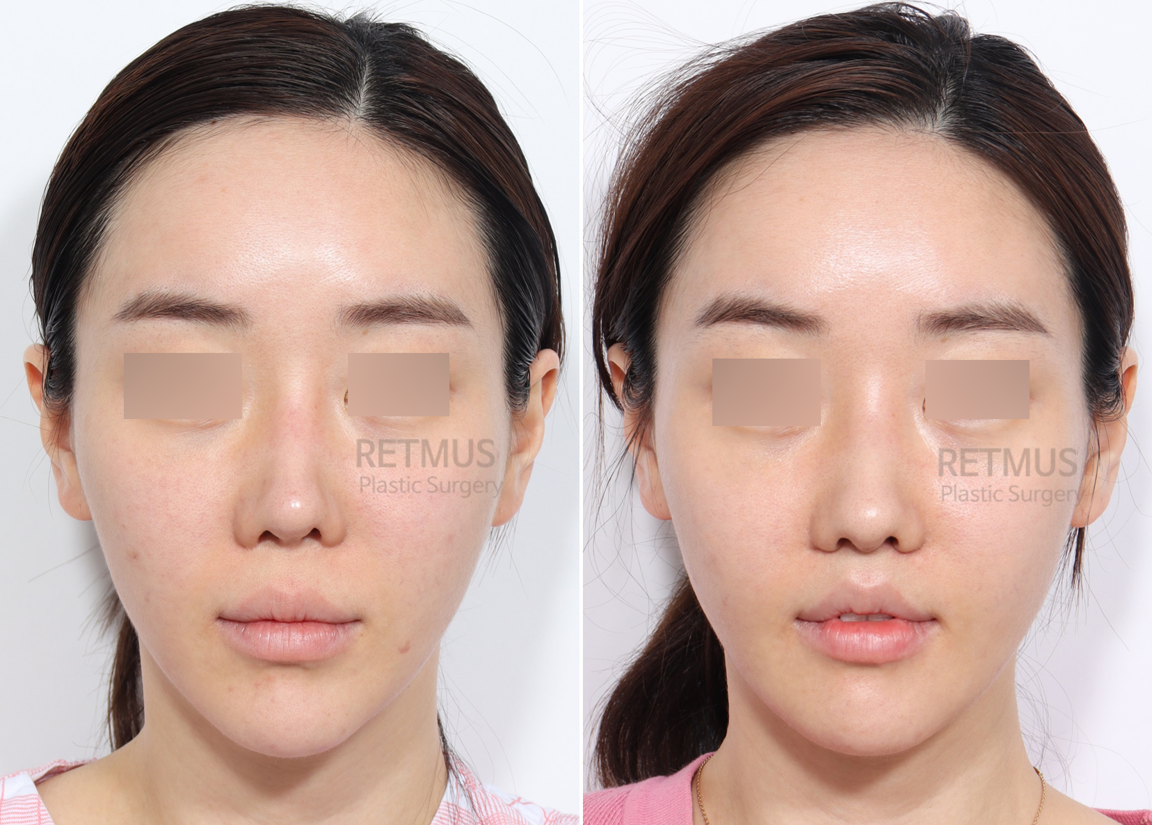 인중코 2주차[인중축소+코재수술] (upper lip lift + revision rhinoplasty)