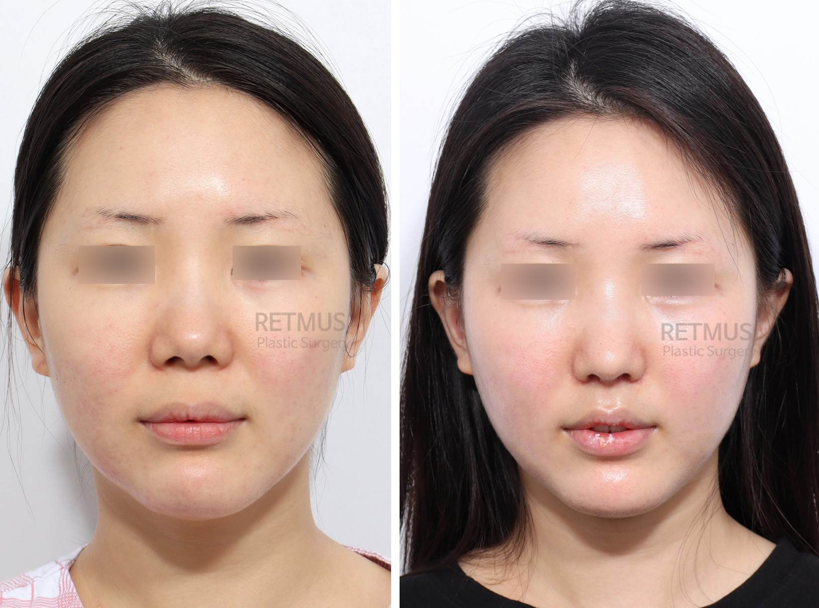 인중코 1개월차 [인중축소+코끝성형] (upper lip lift + alar + nose tip plast…