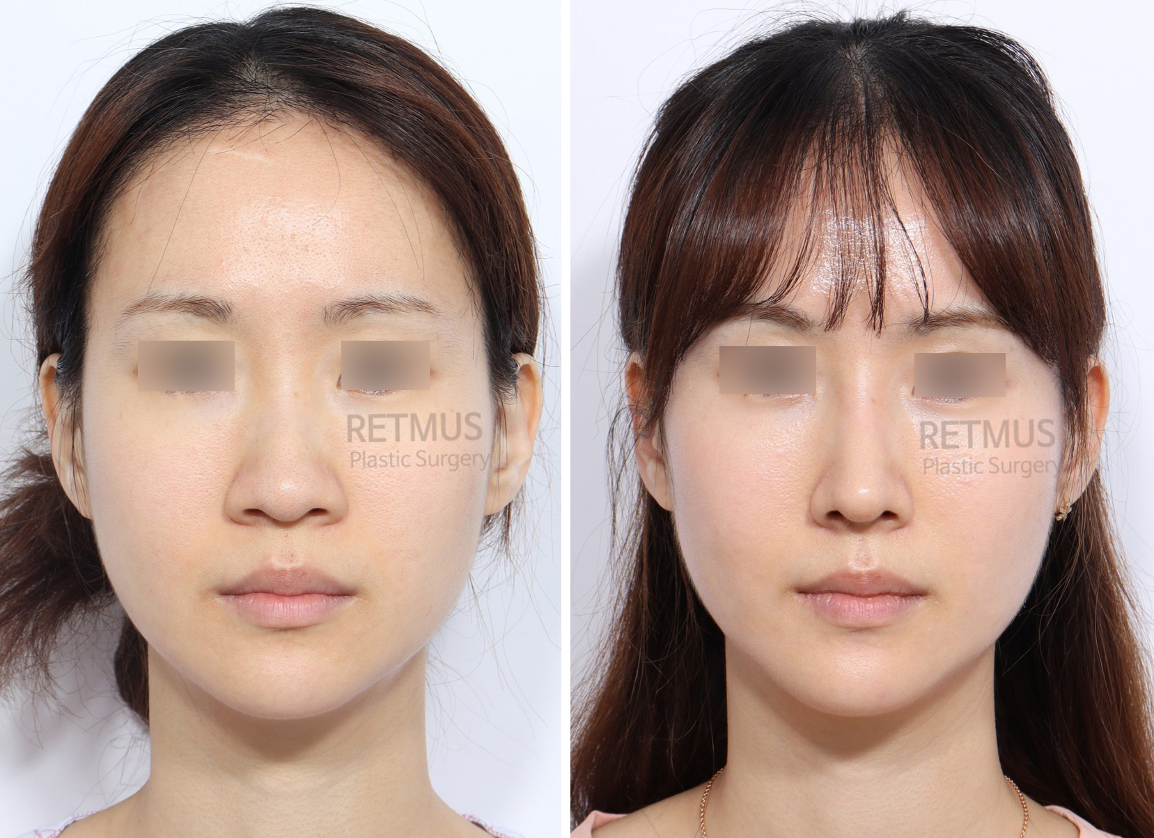 인중코 1개월차 [코성형+콧볼축소] (Rhinoplasty + alar reduction)