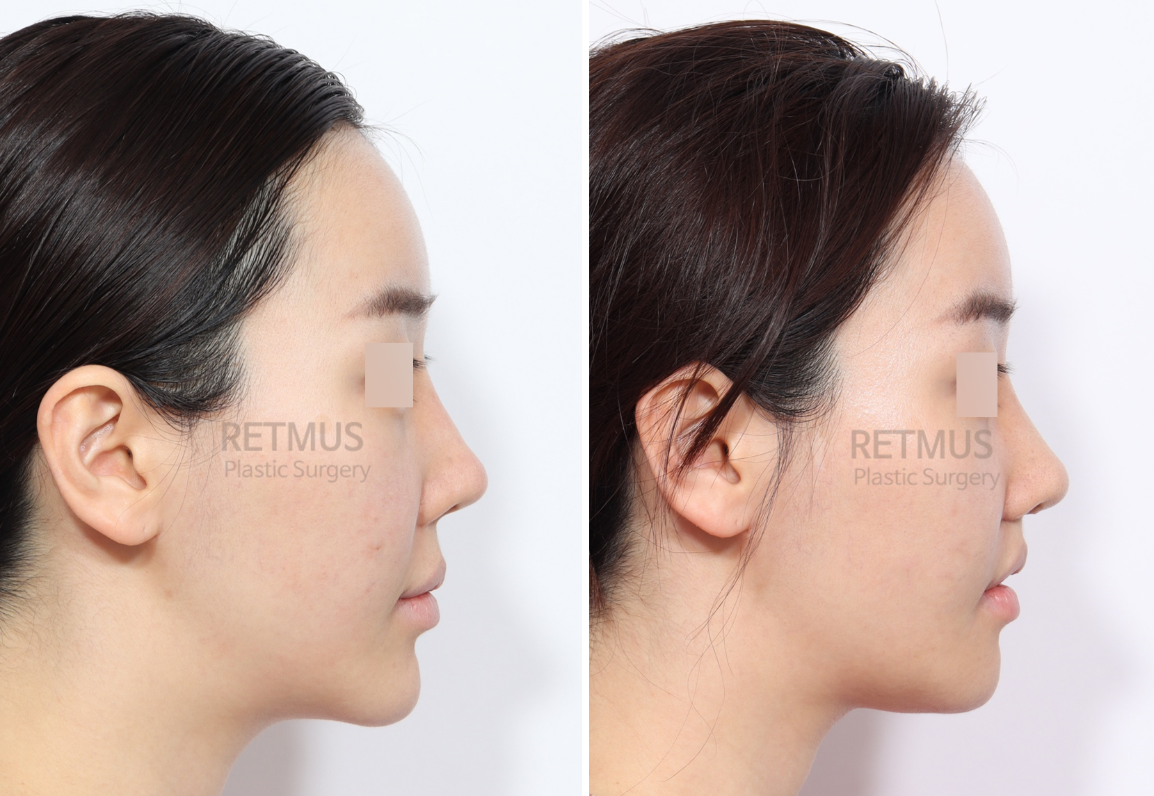 인중코 2주차[인중축소+코재수술] (upper lip lift + revision rhinoplasty)